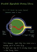 Disorders of the Vitreous Summary and Flashcards