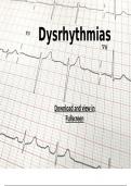 Learning to read 12 lead EKGs and abnormal rhythms 