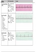 EKG Flash Chart