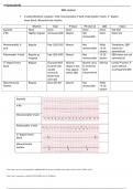 EKG review  6 Lethal Rhythms: Asystole, V-fib, Monomorphic V-tach, Polymorphic V-tach, 3rd degree heart block, Idioventricular rhythm