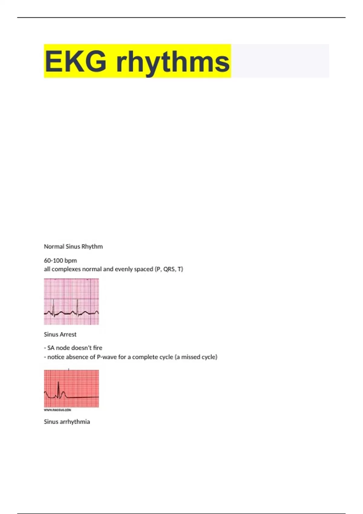 EKG rhythms with correct answers 100% - Ekg - Stuvia US