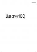 Liver cancer