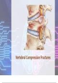 Vertebral Compression Fractures