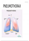 Pneumothorax (Surgery II)