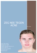 Case report LOEP 5 glycolzuurpeeling bij acne vulgaris. Cijfer: 7.5