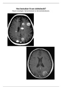 Uitwerking neuro-oncologie