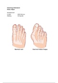 Ziektebeeld Hallux Valgus