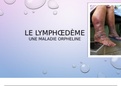 Présentation sur le lymphœdème