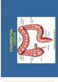 COLORECTAL CANCER- Symptoms, stages, causes, and treatment