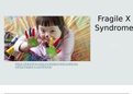 Fragile X Syndrome