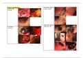 Identifying types of forrest classification & varices from OGDS