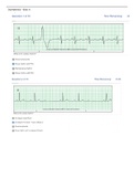 Dysrhythmia - Basic A | Relias Dysrhythmia Basic Test 