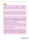 BUNDLE!!! ACLS Exam Version A&B AND ACLS PRE-TEST ASSESSMENTS  latest UPDATE:: ALL ACLS  QUESTIONS ANSWERED CORRECTLY FOR GUARANTEED SUCCESS