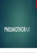  Pneumothorax